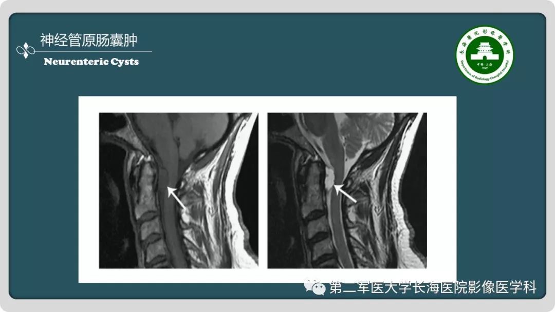 影像PPT - 【PPT】颅内囊性病变影像表现-64