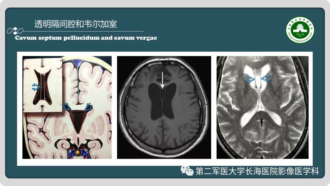 影像PPT - 【PPT】颅内囊性病变影像表现-59
