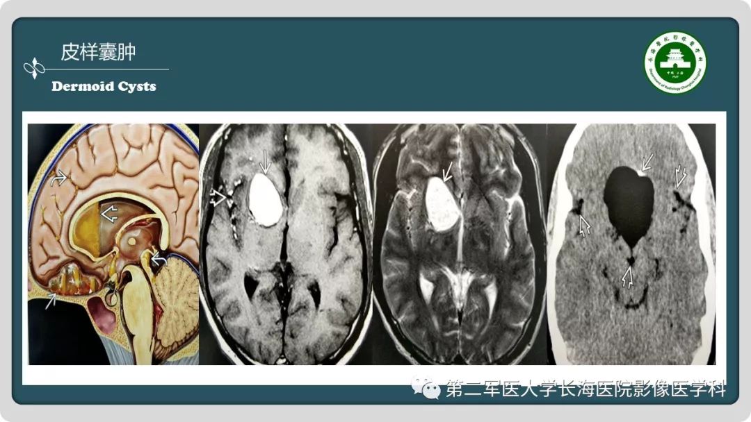 影像PPT - 【PPT】颅内囊性病变影像表现-66