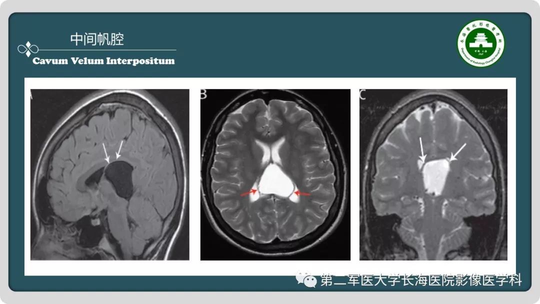 影像PPT - 【PPT】颅内囊性病变影像表现-62
