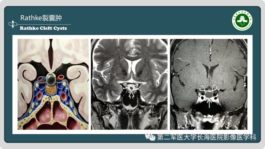 影像PPT - 【PPT】颅内囊性病变影像表现-69