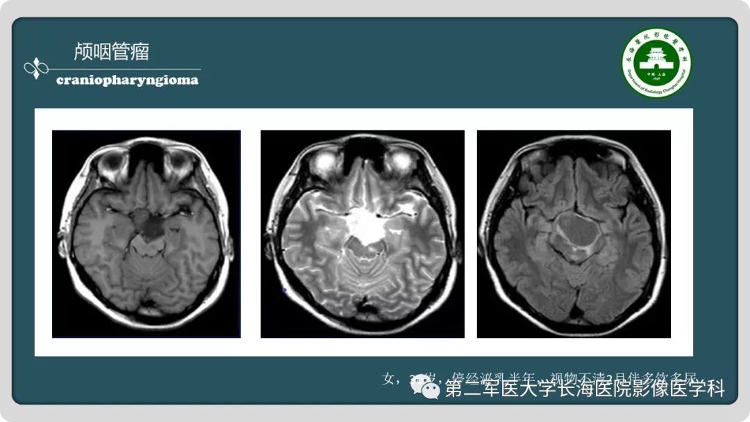 影像PPT - 【PPT】颅内囊性病变影像表现-74