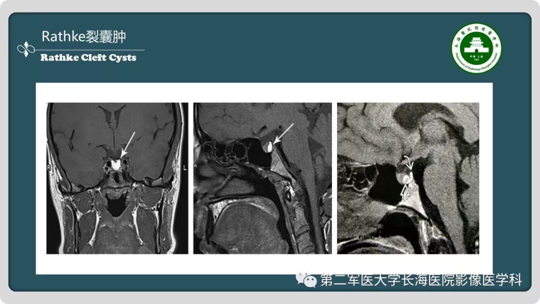 影像PPT - 【PPT】颅内囊性病变影像表现-71