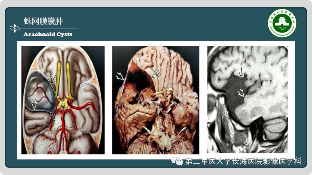 影像PPT - 【PPT】颅内囊性病变影像表现-79