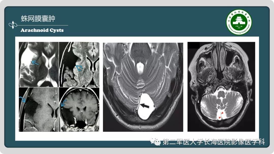 影像PPT - 【PPT】颅内囊性病变影像表现-80
