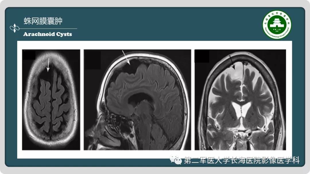 影像PPT - 【PPT】颅内囊性病变影像表现-82