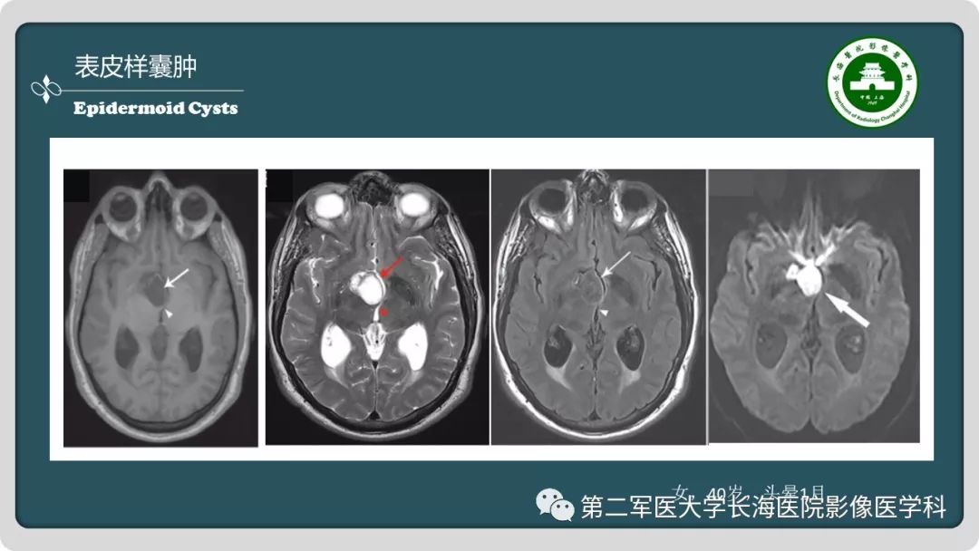 影像PPT - 【PPT】颅内囊性病变影像表现-85