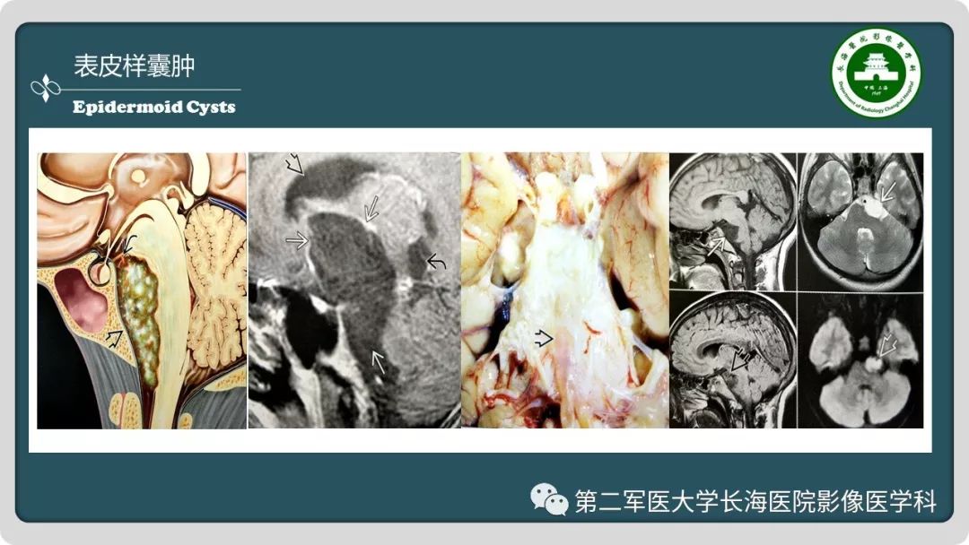 影像PPT - 【PPT】颅内囊性病变影像表现-84
