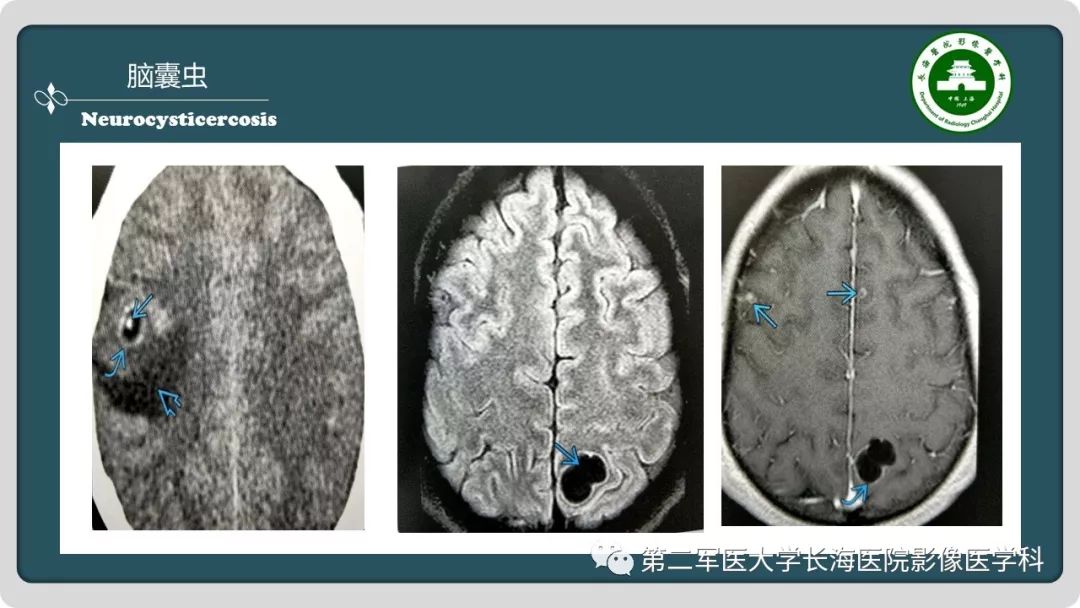 影像PPT - 【PPT】颅内囊性病变影像表现-89