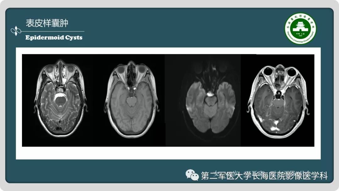 影像PPT - 【PPT】颅内囊性病变影像表现-86