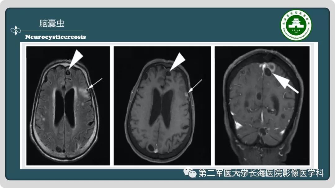 影像PPT - 【PPT】颅内囊性病变影像表现-90