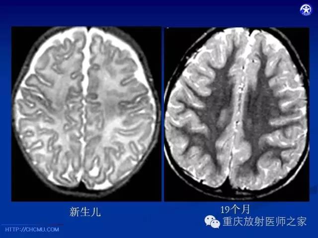 影像PPT - 【PPT】脑白质髓鞘化及相关疾病的MRI表现-2