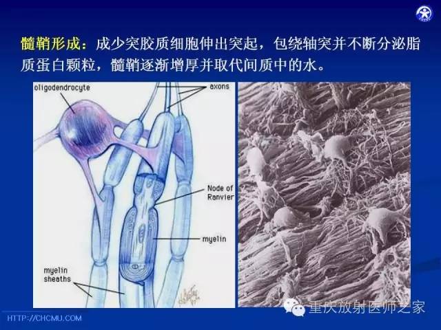 影像PPT - 【PPT】脑白质髓鞘化及相关疾病的MRI表现-4