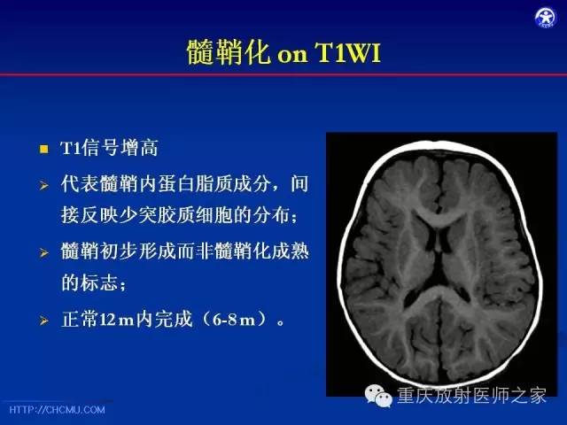 影像PPT - 【PPT】脑白质髓鞘化及相关疾病的MRI表现-6