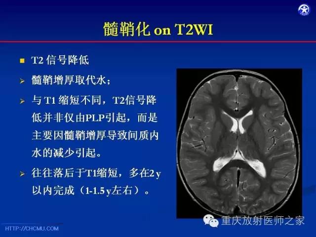 影像PPT - 【PPT】脑白质髓鞘化及相关疾病的MRI表现-7
