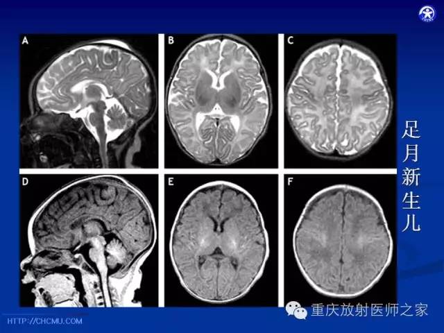 影像PPT - 【PPT】脑白质髓鞘化及相关疾病的MRI表现-9