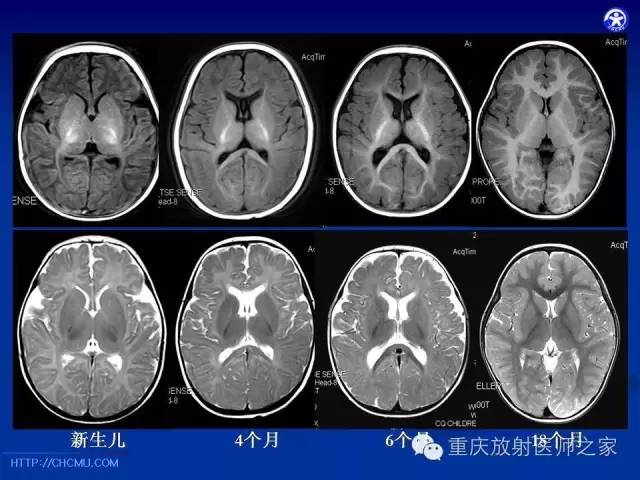 影像PPT - 【PPT】脑白质髓鞘化及相关疾病的MRI表现-10