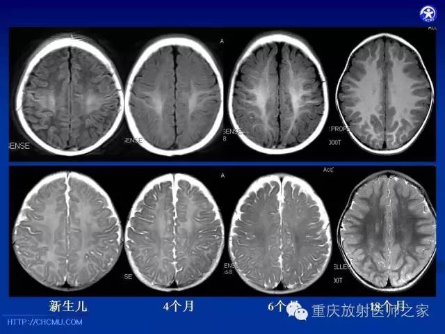 影像PPT - 【PPT】脑白质髓鞘化及相关疾病的MRI表现-11