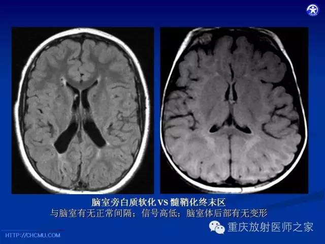 影像PPT - 【PPT】脑白质髓鞘化及相关疾病的MRI表现-14