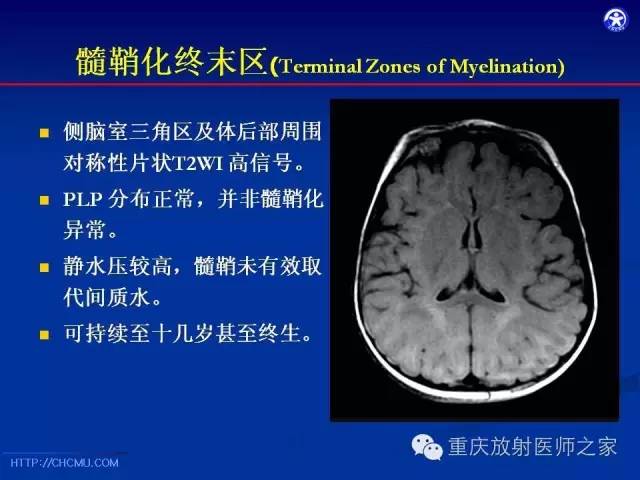 影像PPT - 【PPT】脑白质髓鞘化及相关疾病的MRI表现-13