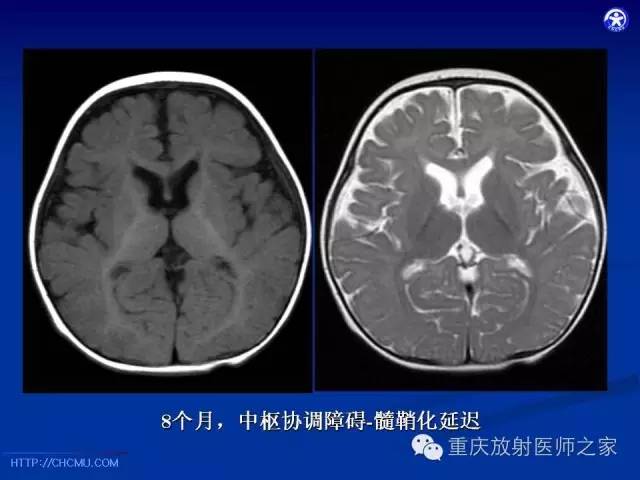 影像PPT - 【PPT】脑白质髓鞘化及相关疾病的MRI表现-15