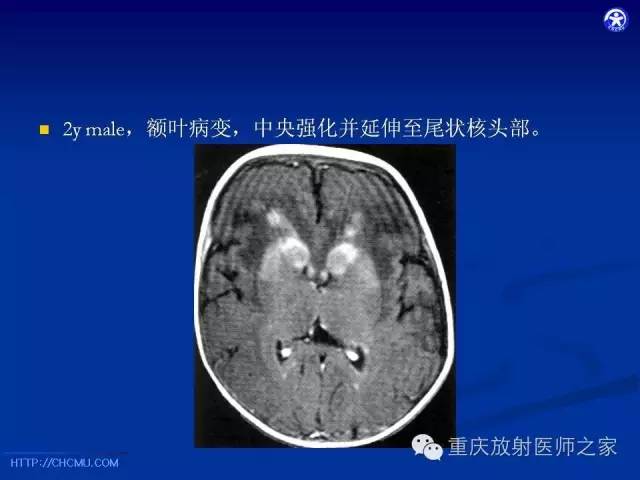 影像PPT - 【PPT】脑白质髓鞘化及相关疾病的MRI表现-22