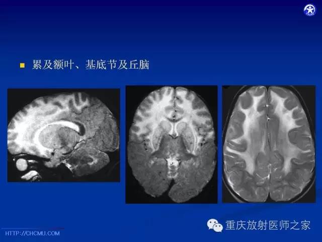 影像PPT - 【PPT】脑白质髓鞘化及相关疾病的MRI表现-23