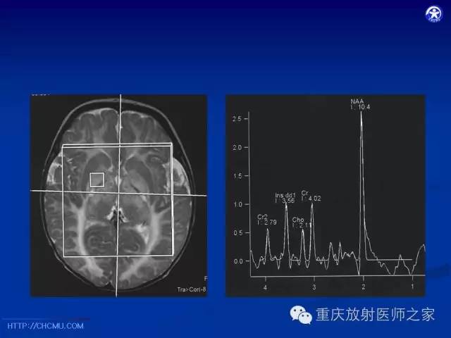 影像PPT - 【PPT】脑白质髓鞘化及相关疾病的MRI表现-26