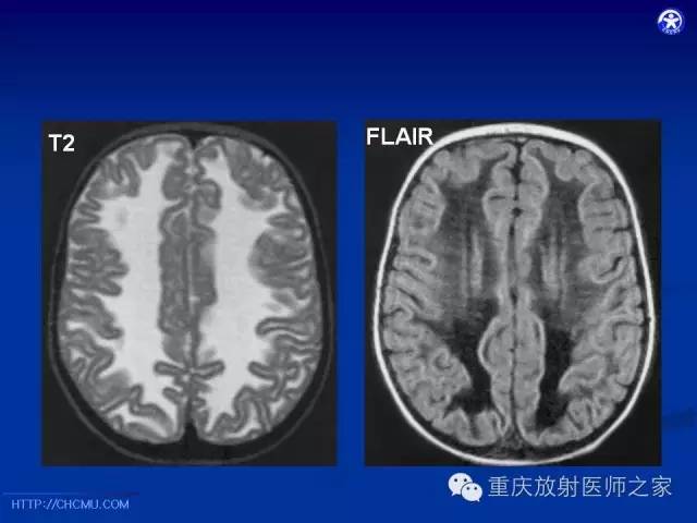 影像PPT - 【PPT】脑白质髓鞘化及相关疾病的MRI表现-29