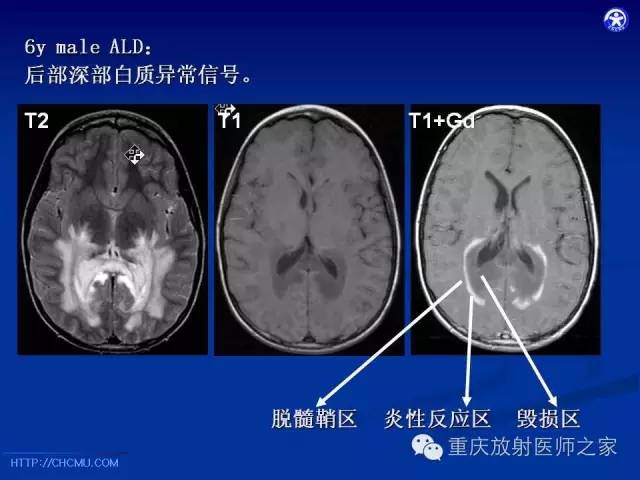 影像PPT - 【PPT】脑白质髓鞘化及相关疾病的MRI表现-33