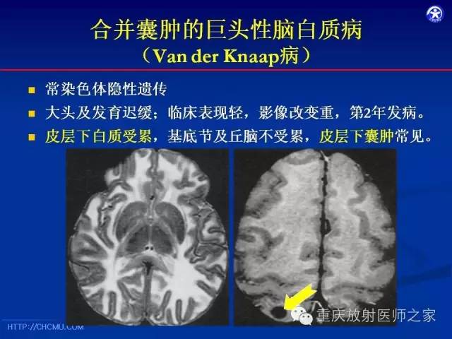 影像PPT - 【PPT】脑白质髓鞘化及相关疾病的MRI表现-27
