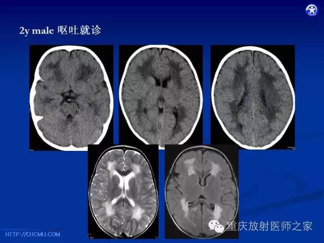 影像PPT - 【PPT】脑白质髓鞘化及相关疾病的MRI表现-36