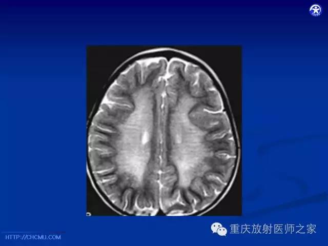 影像PPT - 【PPT】脑白质髓鞘化及相关疾病的MRI表现-37