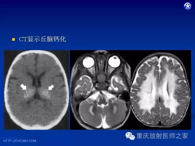 影像PPT - 【PPT】脑白质髓鞘化及相关疾病的MRI表现-31