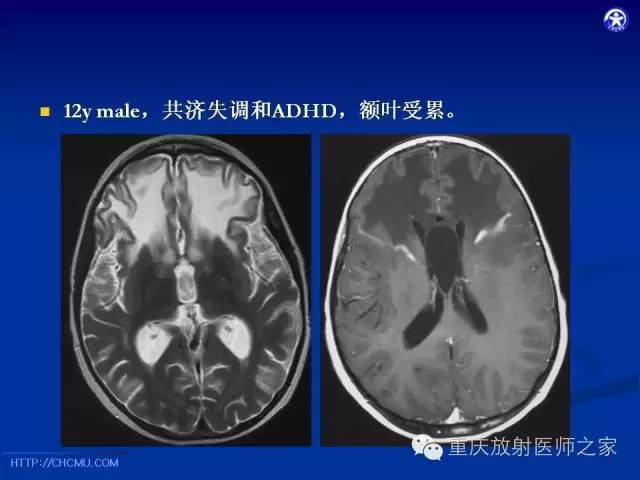 影像PPT - 【PPT】脑白质髓鞘化及相关疾病的MRI表现-34