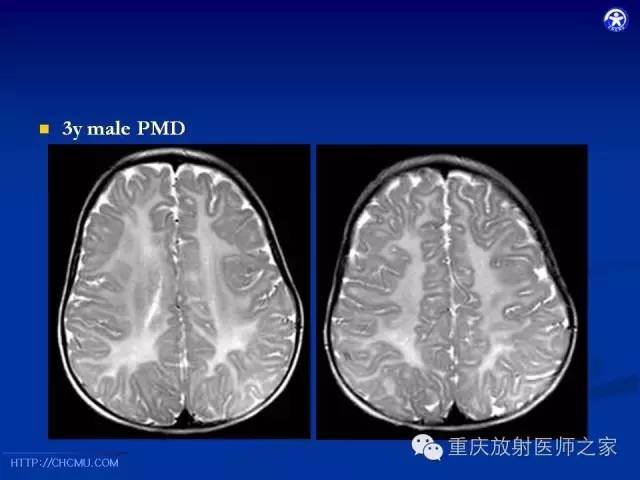 影像PPT - 【PPT】脑白质髓鞘化及相关疾病的MRI表现-39