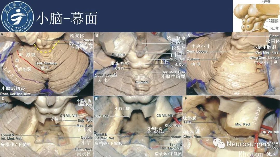 影像PPT - 【PPT】小脑解剖-14
