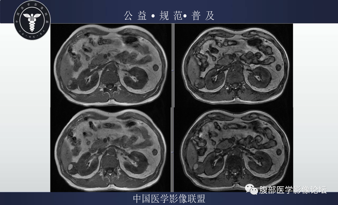 影像PPT - 【病例】肾脏乳头状肾细胞癌1例MR-5