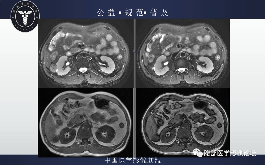 影像PPT - 【病例】肾脏乳头状肾细胞癌1例MR-4