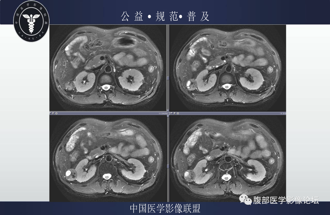 影像PPT - 【病例】肾脏乳头状肾细胞癌1例MR-3