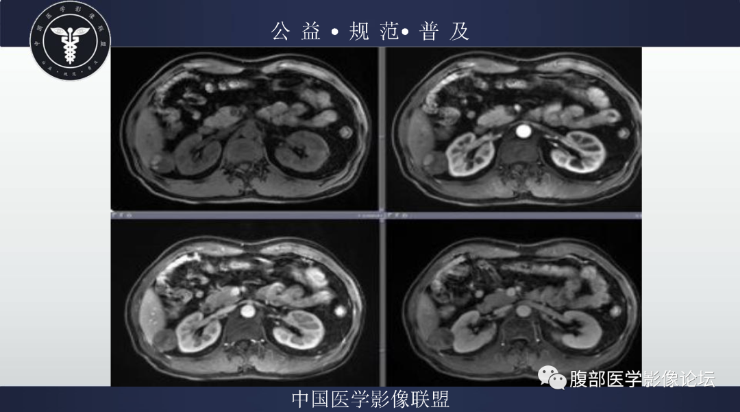 影像PPT - 【病例】肾脏乳头状肾细胞癌1例MR-8