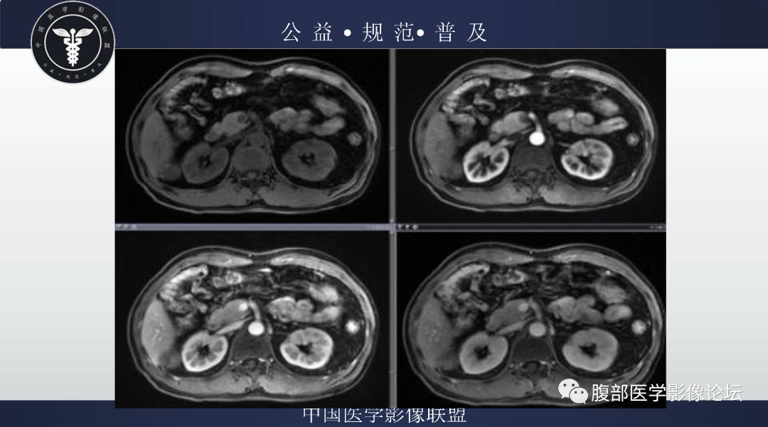 影像PPT - 【病例】肾脏乳头状肾细胞癌1例MR-7