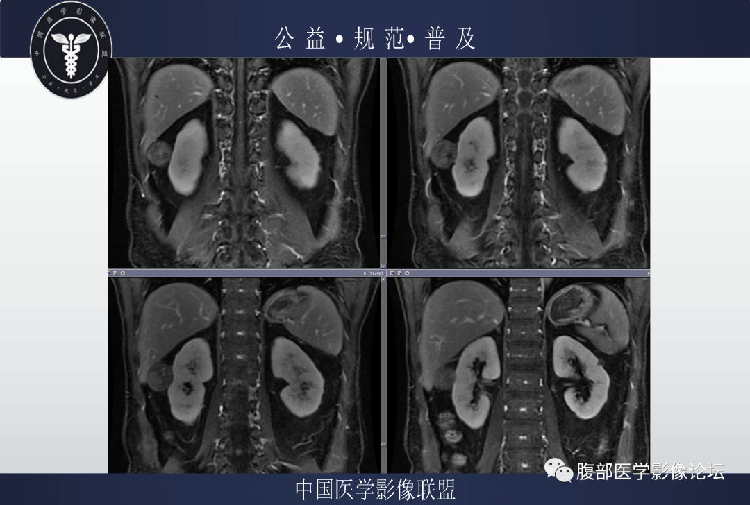 影像PPT - 【病例】肾脏乳头状肾细胞癌1例MR-13