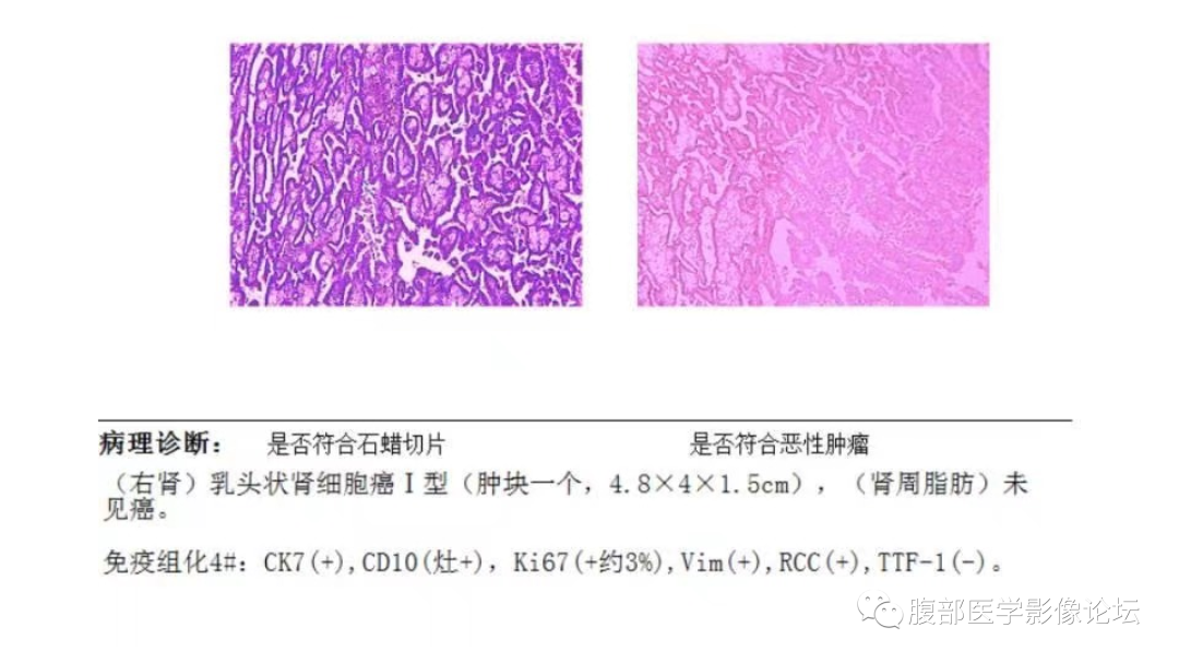 影像PPT - 【病例】肾脏乳头状肾细胞癌1例MR-14