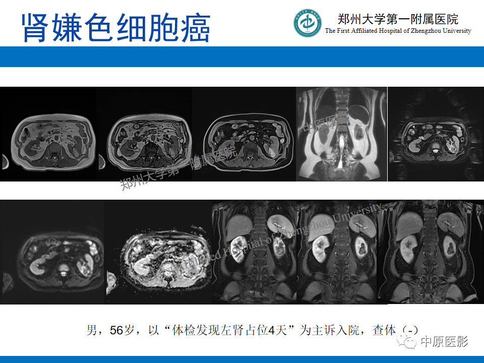 影像PPT - 【病例】肾脏乳头状肾细胞癌1例MR-22