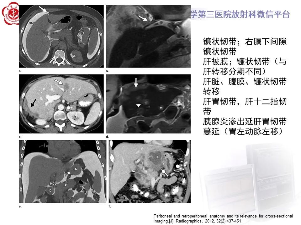 影像PPT - 【PPT】 腹膜及腹膜后解剖及影像-9