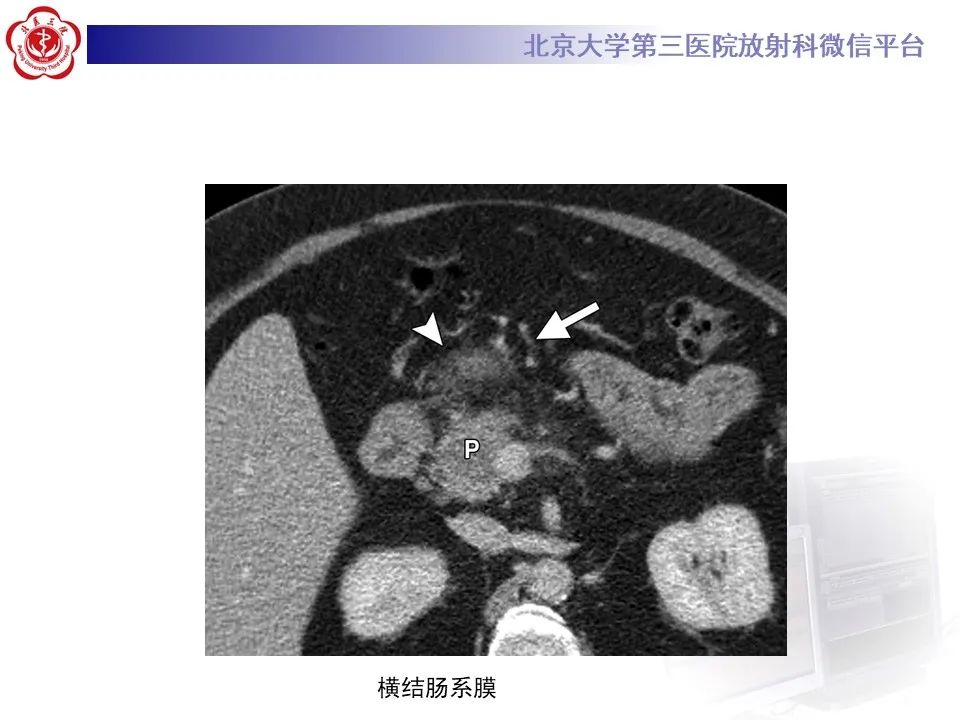 影像PPT - 【PPT】 腹膜及腹膜后解剖及影像-14