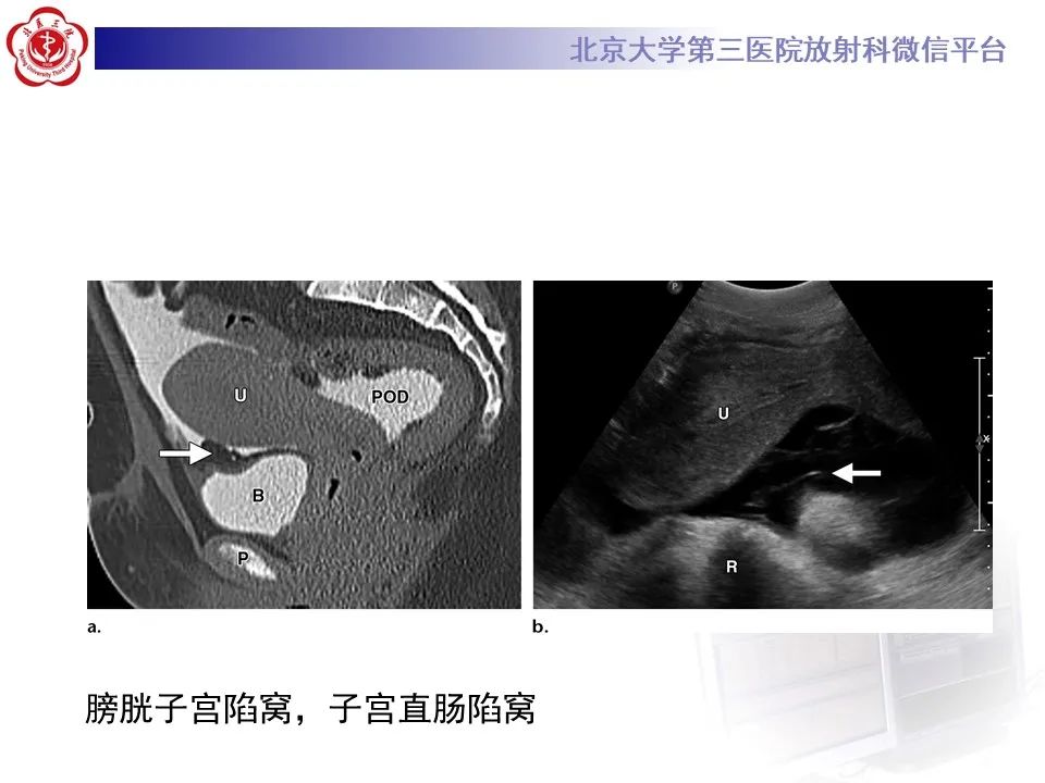 影像PPT - 【PPT】 腹膜及腹膜后解剖及影像-17
