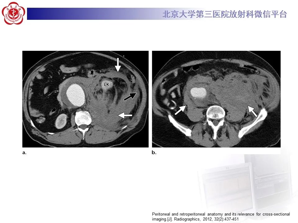 影像PPT - 【PPT】 腹膜及腹膜后解剖及影像-28
