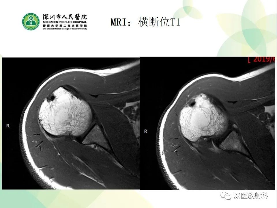 影像PPT - 【病例】Bankart损伤伴Hill-Sachs损伤1例X线MR-4